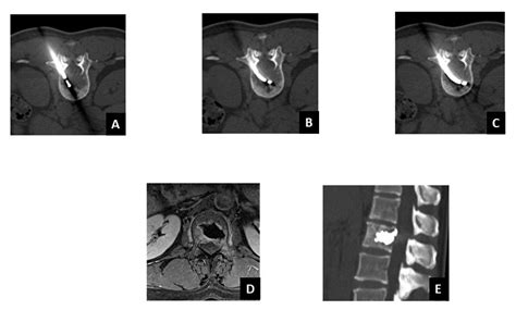 The Role of a Navigational Radiofrequency Ablation Device and ...