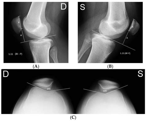 Subluxation Knee