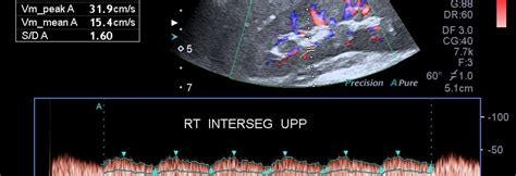 AORTOARTERITIS WITH B/L RAS – Case By Dr. Nitin Jadhav