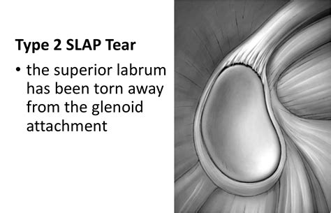 Slap Tear Surgery Failure