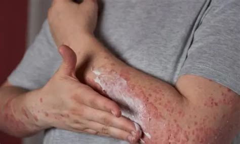 Chronic air pollutant exposure increase the risk of systemic lupus ...