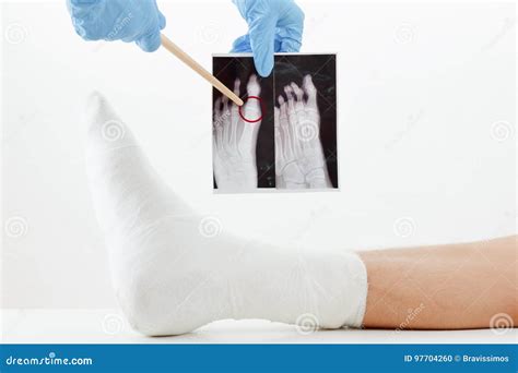 X-ray Image Of Broken Leg, Show Tibia And Fibula Fractures. Royalty-Free Stock Photo ...