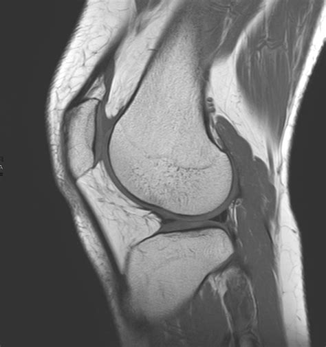 Bucket Handle Injury