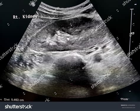 244 imágenes de Renal stones ultrasound - Imágenes, fotos y vectores de stock | Shutterstock