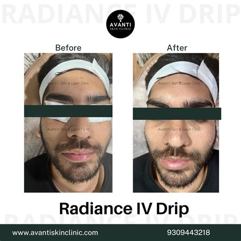 Image result for Small Dimples