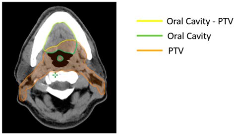 Implementation, Dosimetric Assessment, and Treatment Validation of ...