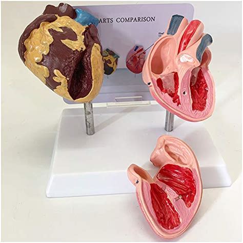 Buy ZHTY Human Heart Model - Human Organ Anatomy Model - Pathological ...