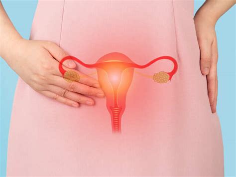 Ovarian Cyst: What Every Indian Woman Should Know About This Silent ...