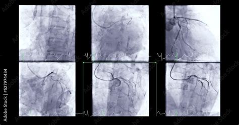 Coronary Angiogram Procedure 的图像结果
