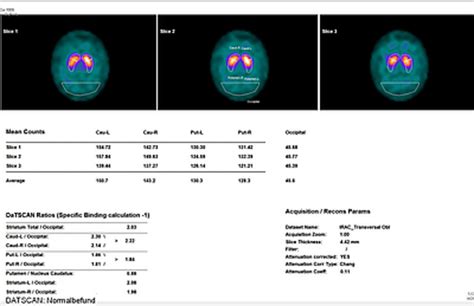 Image result for Normal DaTscan