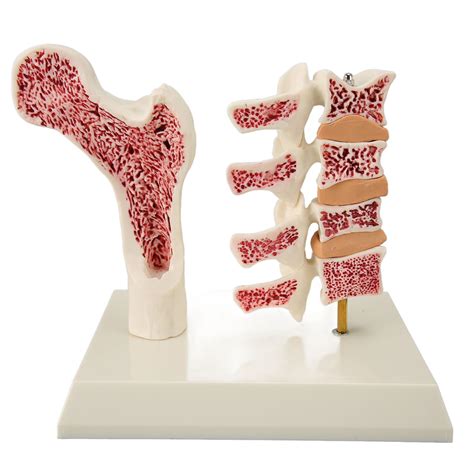 Osteoporosis Spine Model For Teaching Demonstration Visualize Bone ...