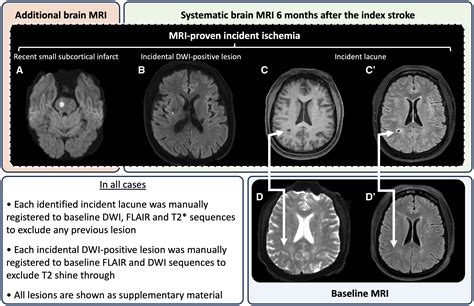 MRI-Proven Incident Ischemia: A New Marker of Disease Progression in Small Vessel Diseases | Stroke