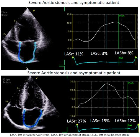 The Clinical Applications of Left Atrial Strain: A Comprehensive Review ...