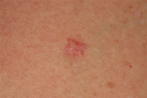 Cáncer de piel o melanoma? No: Carcinoma de células basales! - DocCheck