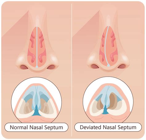Why do I often have stuffy nose (nasal congestion) when lying down? How to solve the problem ...