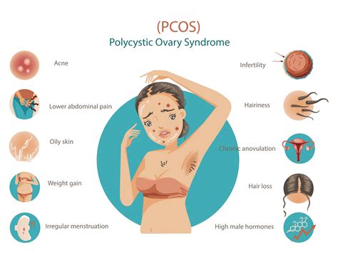 Managing Polycystic Ovary Syndrome: Symptoms & Treatment