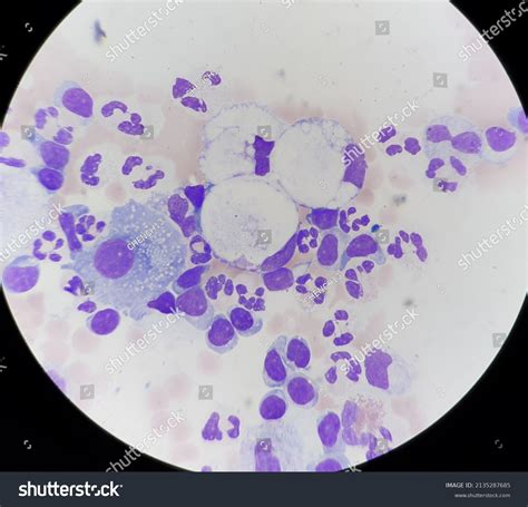 Signet Ring Cells Body Fluid Stock Photo 2135287685 | Shutterstock