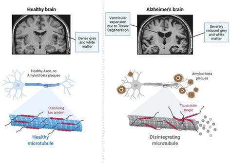 Immunotherapies for Alzheimer’s Disease—A Review