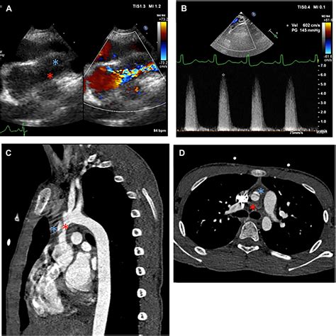Aortic Dissection and Supravalvular Aortic Stenosis With Williams ...