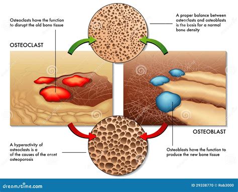 Osteoblast & Osteoclast Stock Vector - Illustration of cell, primary ...