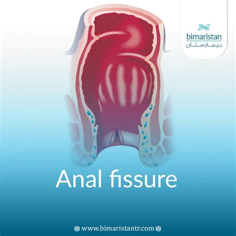 Anal Fissure: Main Causes and Treatment Methods - Bimaristan