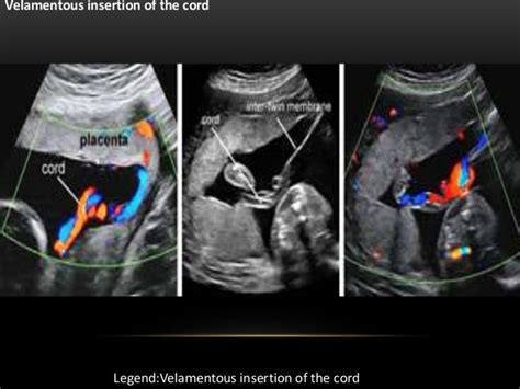Bildergebnis für velamentous umbilical cord ultrasound