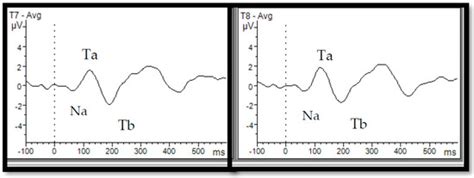 Temporal and Fronto-Central Auditory Evoked Responses in Children with ...