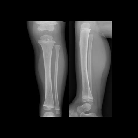 Toddler Fracture | Pediatric Radiology Reference Article | Pediatric Imaging | @pedsimaging