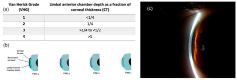 Anterior Chamber Angle