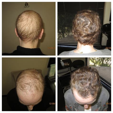 Hair Growth After Chemo: Treatment & Solutions in Houston, TX | TM Hair