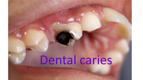 ATTRITION OF TEETH (Regressive Alterations of Teeth) | PPTX