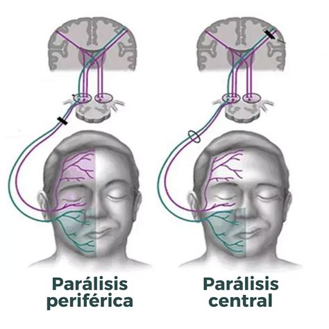 Cómo saber si padezco una Parálisis facial? – FisioClinics Palma de Mallorca | Osteopatía Palma