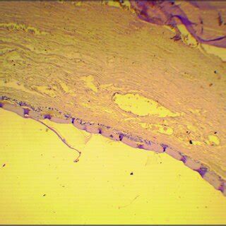 Image result for Dissected Appendix