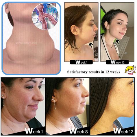 Thyroid gland lymph node relief patch – APWETY