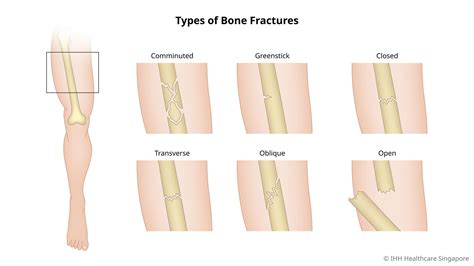 Bone Fractures - Symptoms & Causes | Parkway Shenton