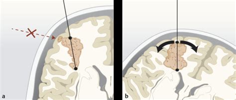 Image result for Keyhole Method