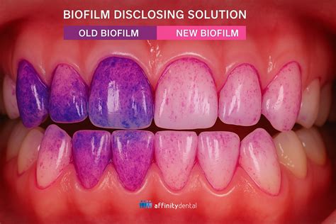 AIRFLOW® Cleaning now available in Affinity Dental Clinics Cebu