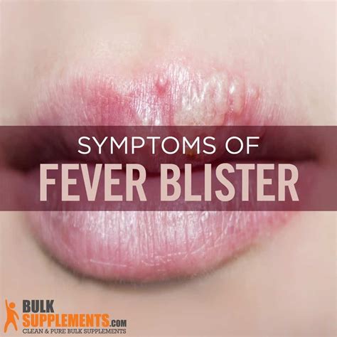 How To Get Rid Of Fever Blisters On Lips | Lipstutorial.org