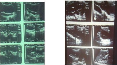 Pediatric Nephrology : Posterior Urethral Valves : Posterior Urethral ...