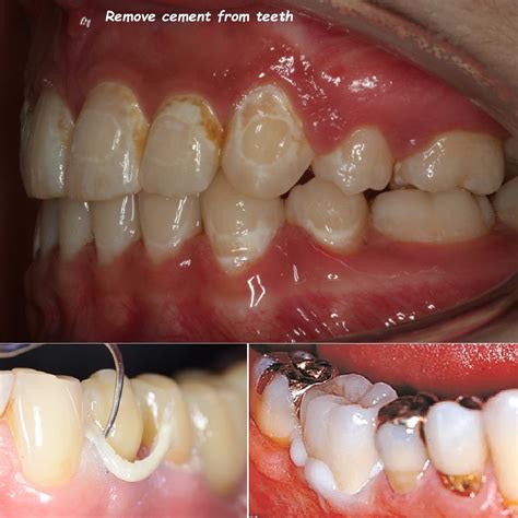 Image result for How to Remove Teeth Video