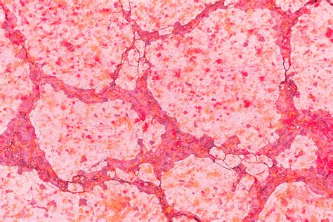 What is the PUS Cells in Urine Normal Range? What is the Diagnosis ...