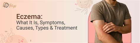 What Is Eczema? Symptoms, Types & Effective Treatments – DreamyDerma