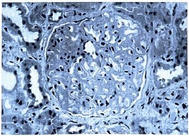 Tuberculosis - Medical Science Optional Notes for UPSC PDF Download