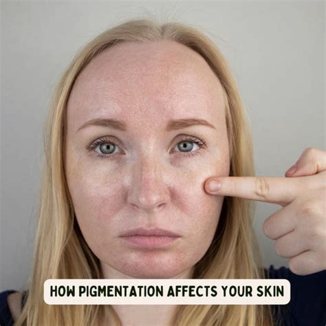 Strategies to Permanently Remove Facial Pigmentation | Clinikally