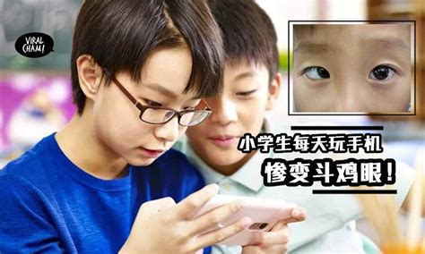 【留意你的小孩!】9岁男童假期沉迷玩手机『惨变斗鸡眼』影响视力 😱 医生: 要动手术…