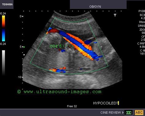 Bildergebnis für umbilical cord ultrasound images
