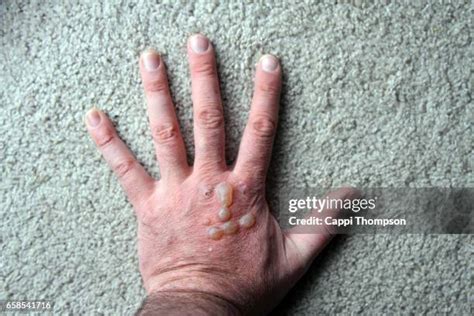 Image result for Exploding Orange Hand Injury