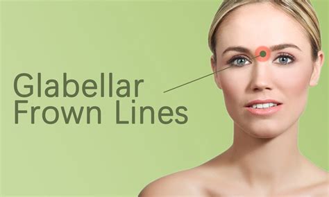 Glabellar Lines Treatment in Surat - Elegance Clinic