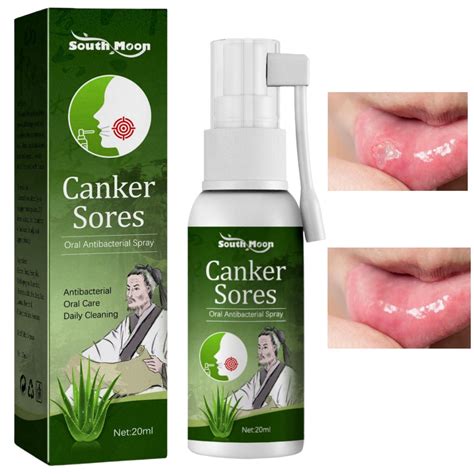 Buy Mouth Ulcer Spray,Mouth Ulcer Spray,Mouth Ulcer Spray,Canker Sore ...