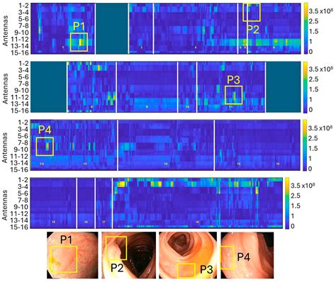 New Concept of Colonoscopy Assisted by a Microwave-Based Accessory ...